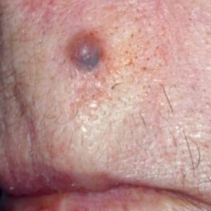 BASAL CELL CARCINOMA (BCC)