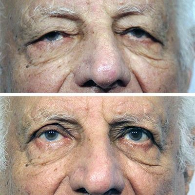 eyelid-surgery_before_after2