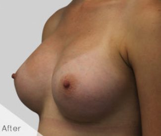breasts-2A-300×251