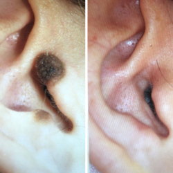 Scarless Lesion Removal Ear