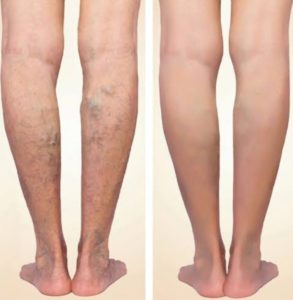 Varicose Vein removal before and after 1