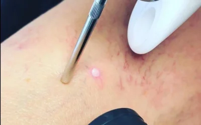 vein